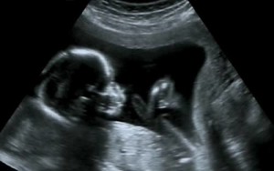ecografia-feto-gravidanza-shutterstock_140518024